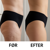cellulite behandling