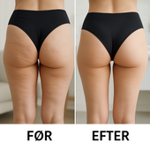 appelsinhud behandling