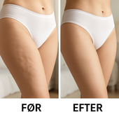 appelsinhud på lår